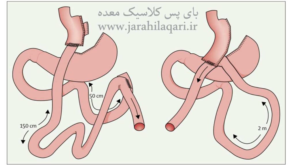 بای پس کلاسیک معده 