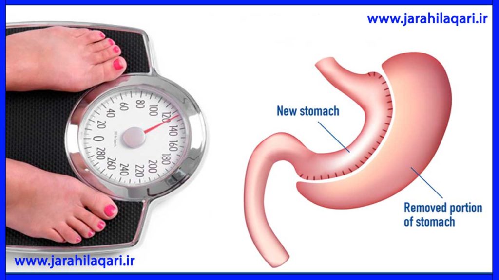 تاثیرات عمل جراحی اسلیو 