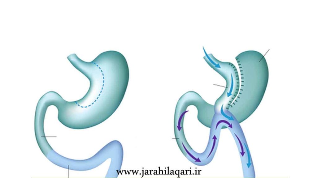 ایمن ترین جراحی لاغری