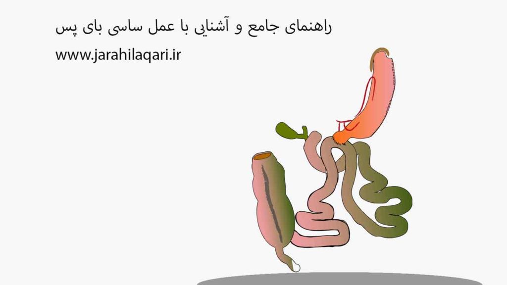 راهنمای جامع و آشنایی با عمل ساسی بای پس