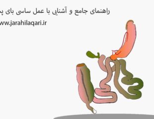 راهنمای جامع و آشنایی با عمل ساسی بای پس