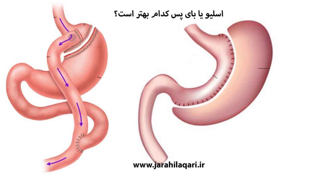 اسلیو یا بای پس