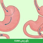 بای پس معده