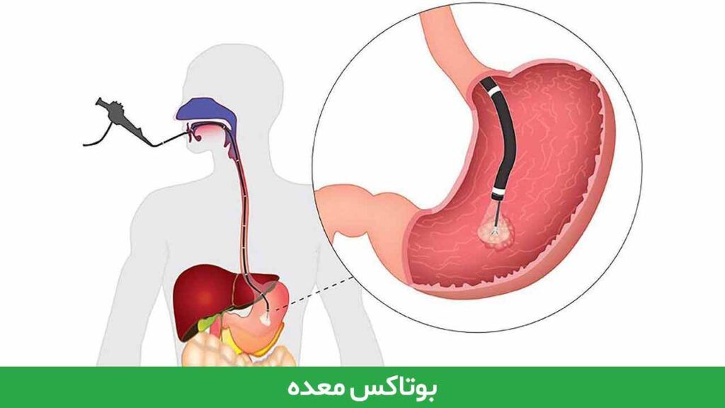 بوتاکس معده