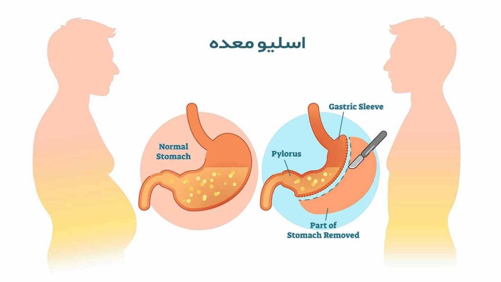 عمل اسلیو معده