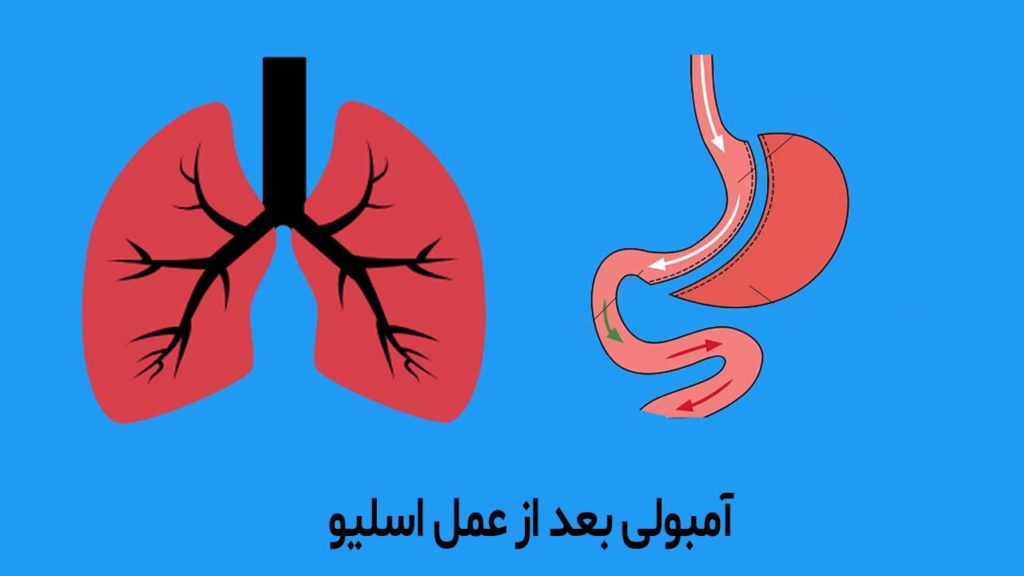 آمبولی بعد از عمل اسلیو