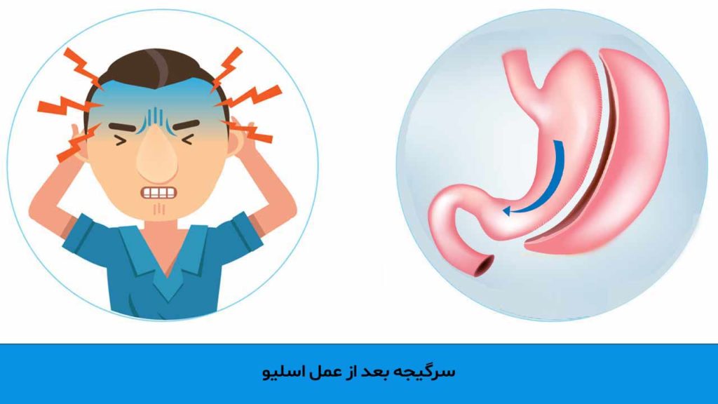 سرگیجه بعد از عمل اسلیو