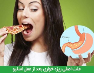 علت اصلی ریزه خواری بعد از عمل اسلیو