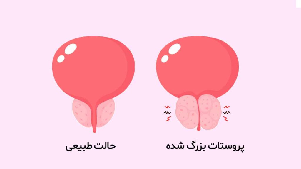 روش های تشخیص بیماری پروستات