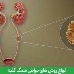 روش های جراحی سنگ کلیه