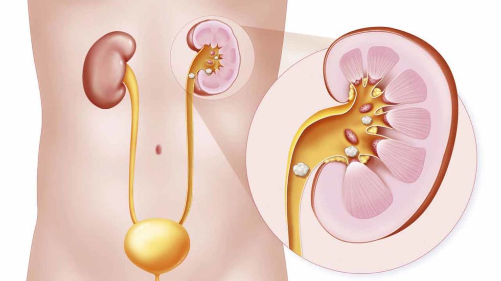 جراحی های سنگ کلیه