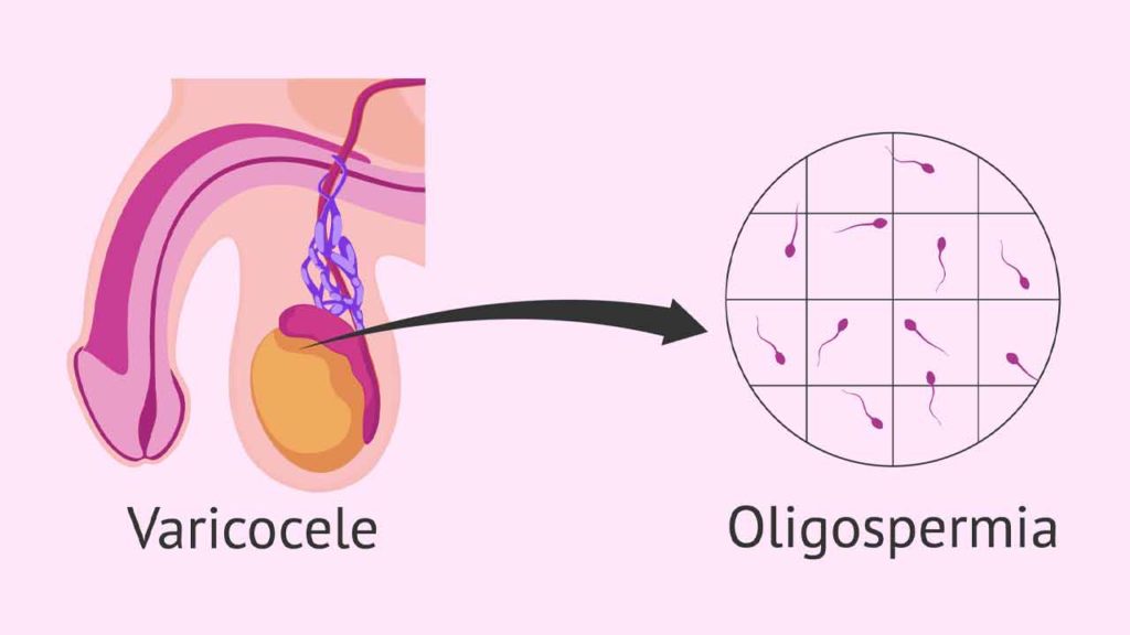 علت ایجاد واریکوسل در بیضه