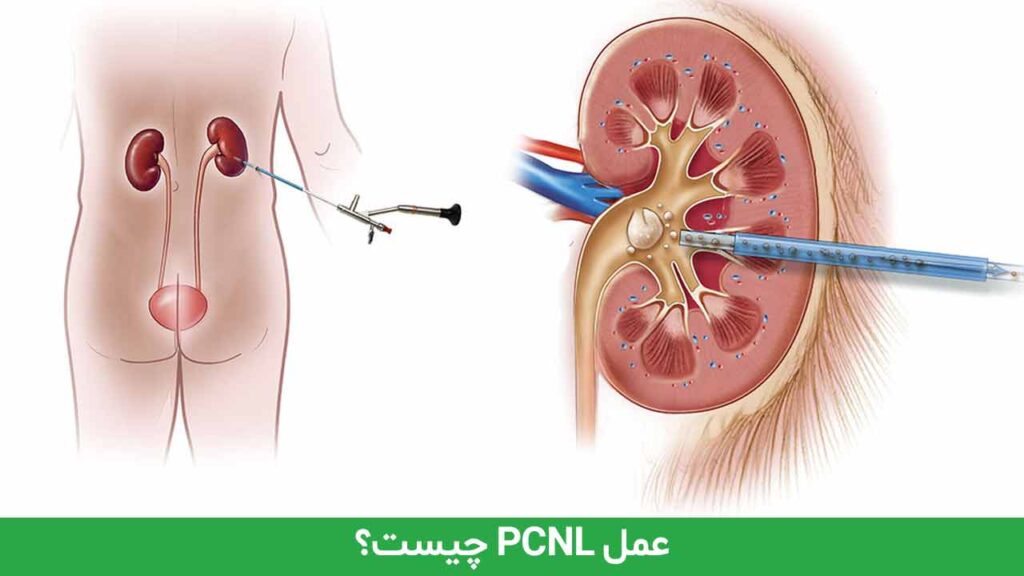 عمل PCNL چیست؟