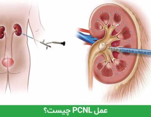 عمل PCNL چیست؟