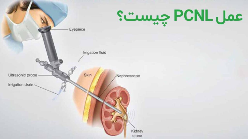 عمل PCNL چیست؟