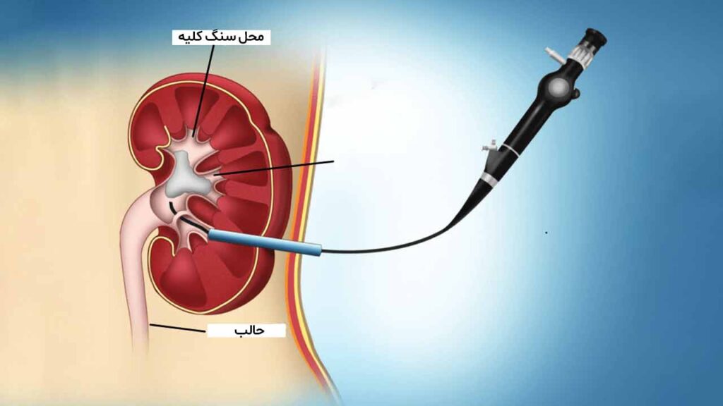 مراحل انجام عمل PCNL