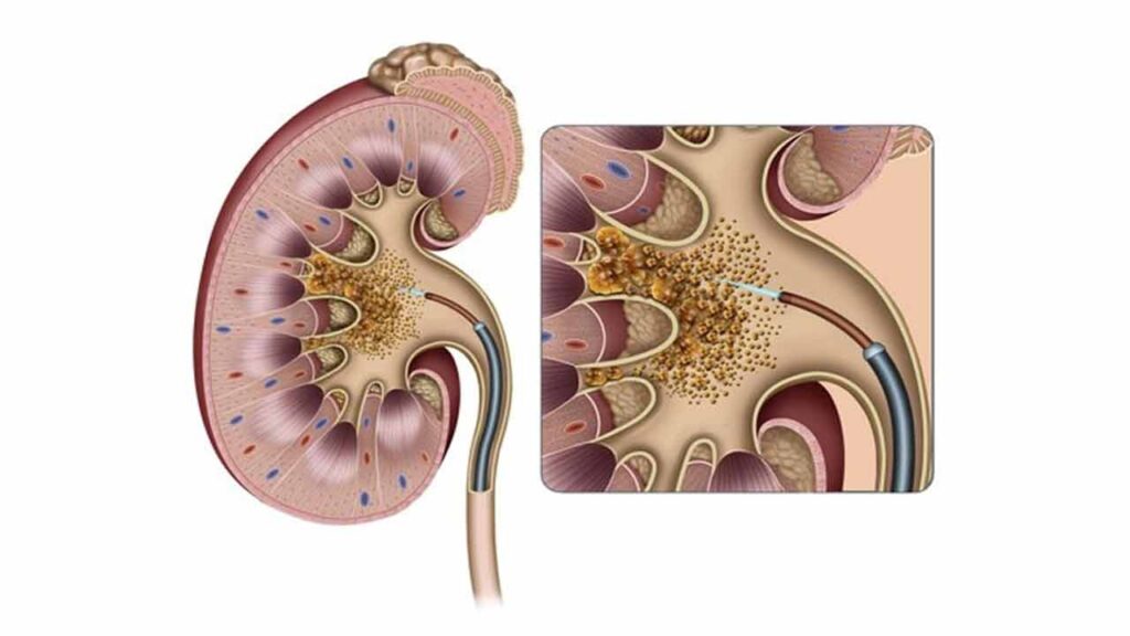 آمادگی های لازم قبل از عمل RIRS