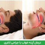 درمان آپنه خواب با جراحی لاغری