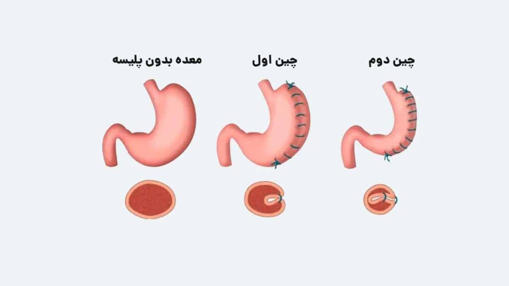 جمع بندی درباره عمل پلیسه معده