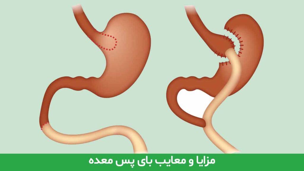 مزایا و معایب بای پس معده