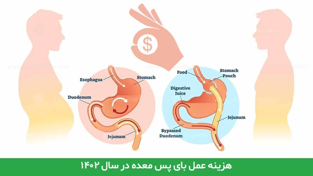 هزینه عمل بای پس معده در سال ۱۴۰۲