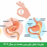 هزینه عمل بای پس معده در سال ۱۴۰۲