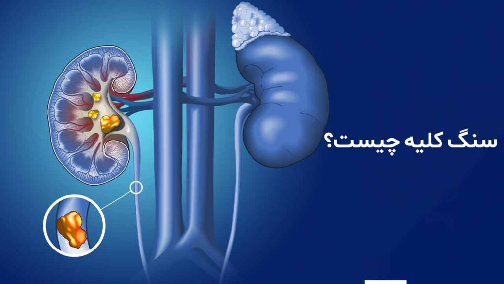 سنگ کلیه چیست؟