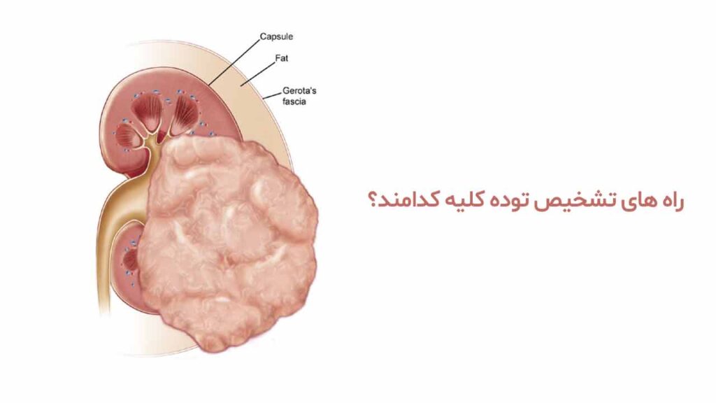 راه های تشخیص توده کلیه