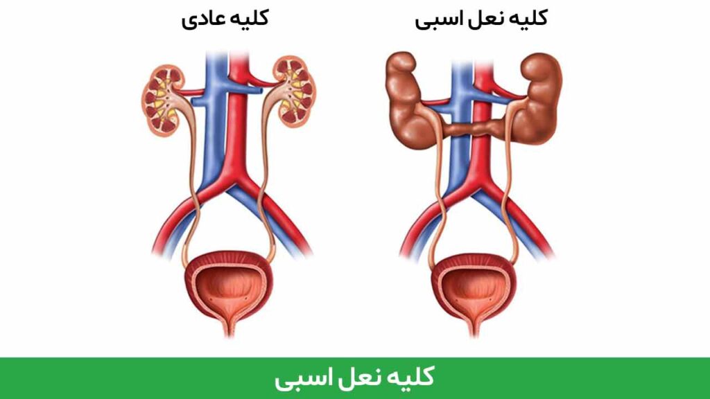 کلیه نعل اسبی