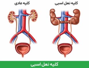 کلیه نعل اسبی