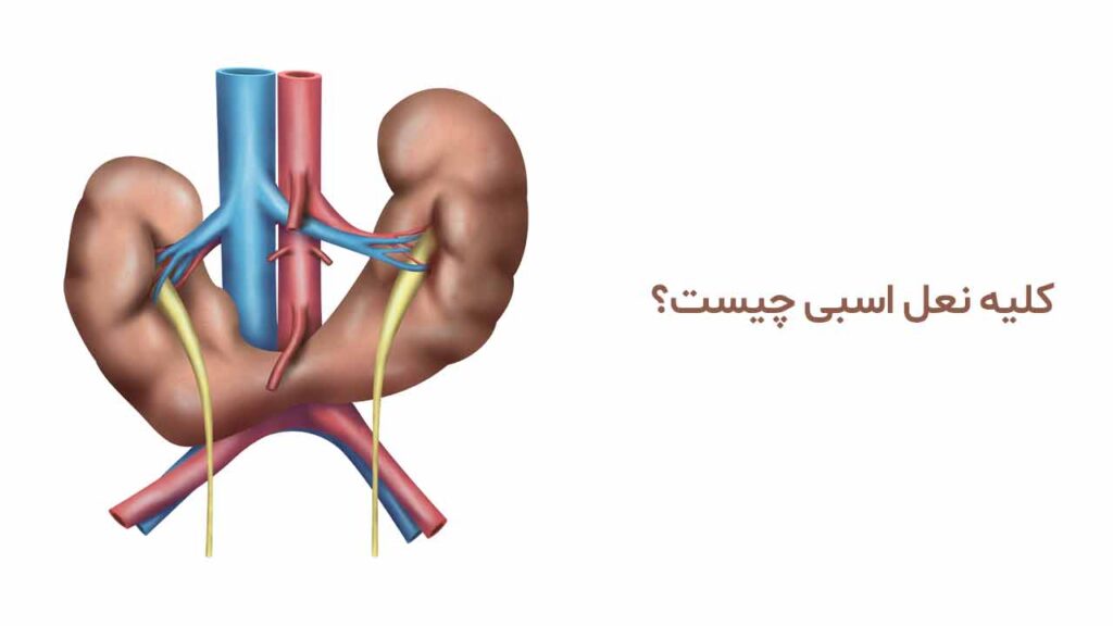 کلیه نعل اسبی چیست؟