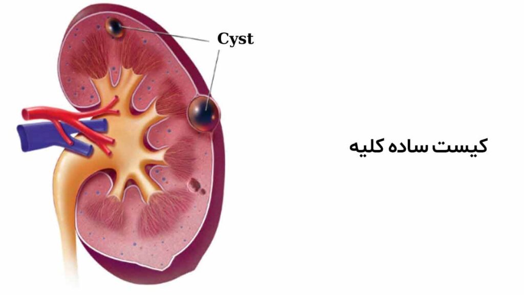 کیست ساده کلیه چیست؟