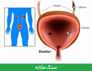 سنگ مثانه