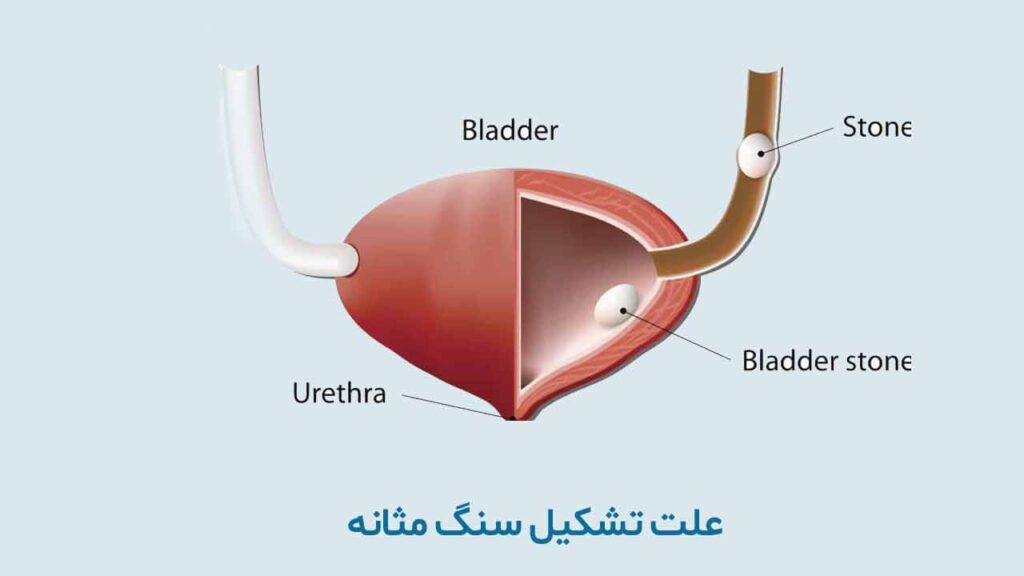 علت تشکیل سنگ مثانه